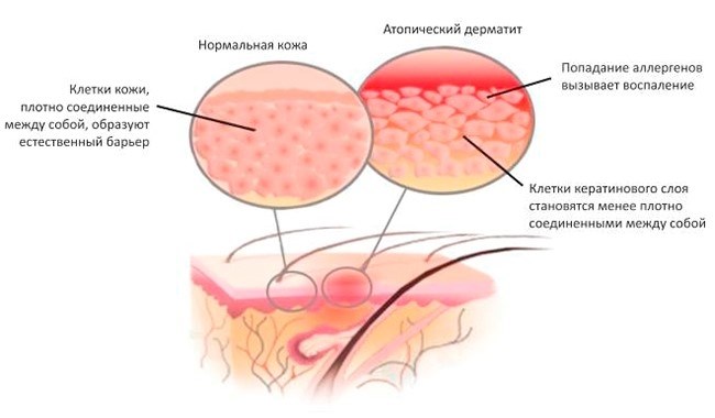 Как выглядит дерматит